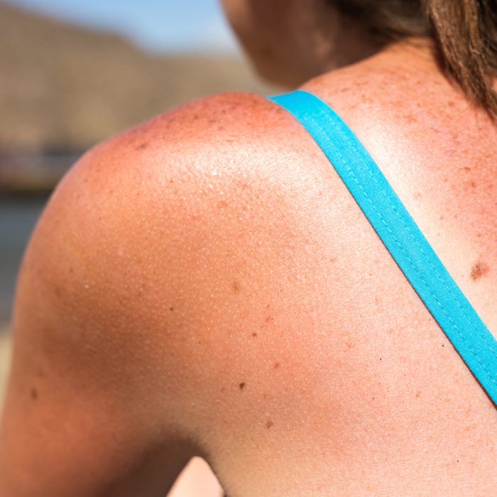 Sunburn from beach sun light on the shoulder and back of caucacian girl