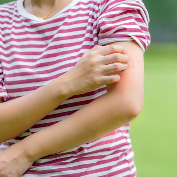 Women who are itching from insect bites in the grass. / Health care and medicine.; Shutterstock ID 1016599672; Job (TFH, TOH, RD, BNB, CWM, CM): Taste of Home