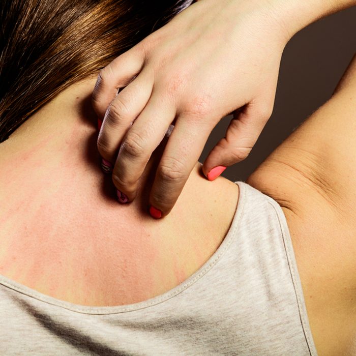Closeup young woman scratching her itchy back with allergy rash