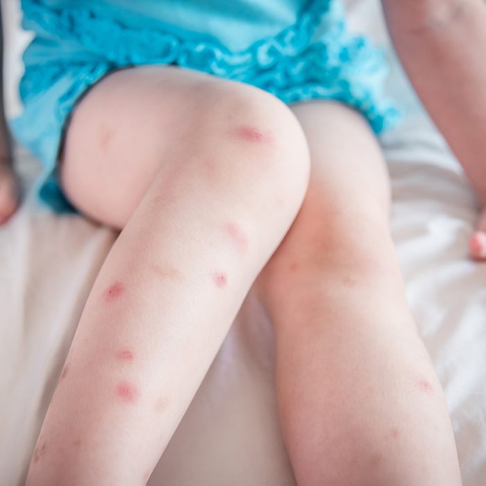 Many of mosquito bites sore and scar on little child legs who sitting on bed