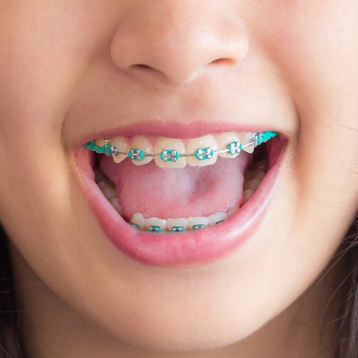 a smile mouth of asian girl and she has green braces