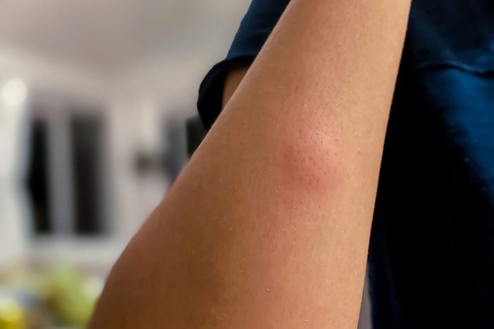 Mosquito Bite Gettyimages 1254940667