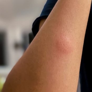 Mosquito Bite Gettyimages 1254940667